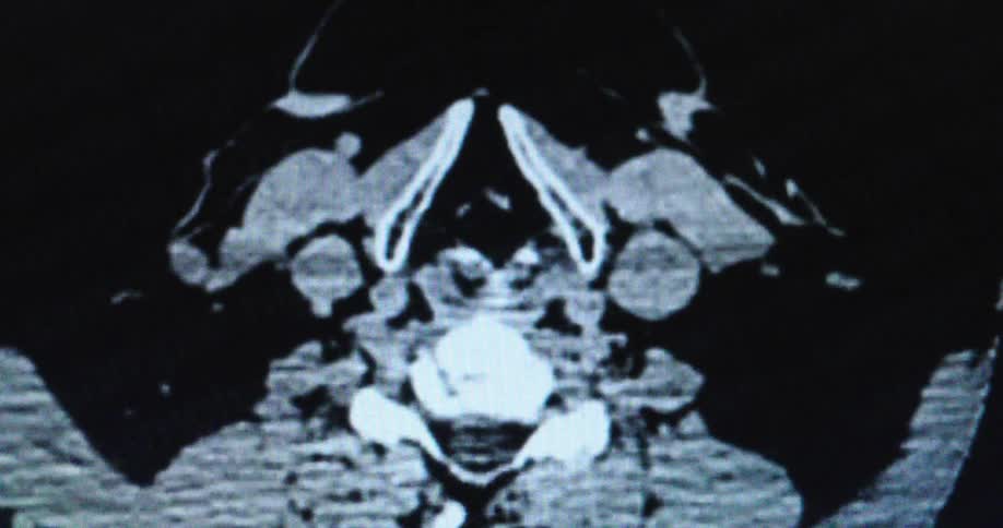 An axial ct scan displayed on a screen likely showing a retropharyngeal abscess