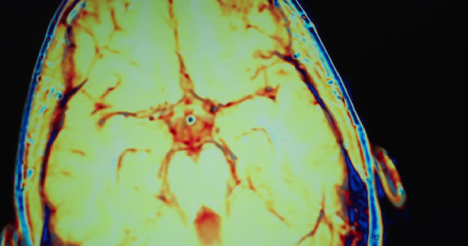 A medical scan shows a crosssection of a persons head with various colors highlighting different parts of the brain the view shifts to show a different angle of the brain with the red yellow and blue colors pulsing