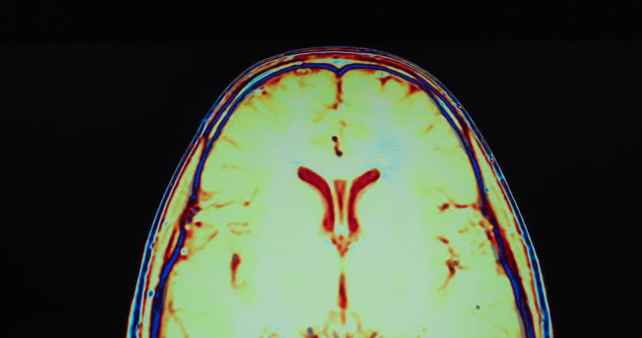 Medical imaging of a brain is glowing