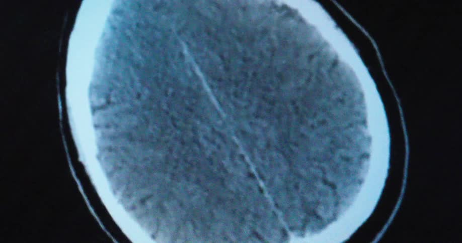 An mri scan reveals a top down cross sectional view of the human brain