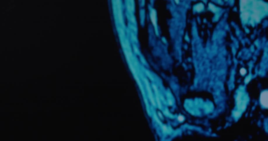 A blue and black medical scan of a human brain slowly pans from right to left on a dark screen