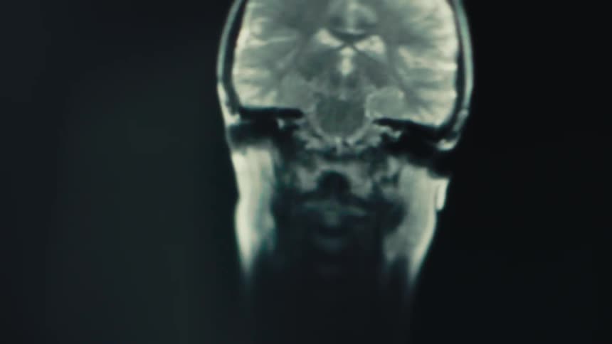 MRI scan visualizing lateral cross-section of a human head with brain structures and vertical symmetry in focus, highlighting detailed diagnostic imaging