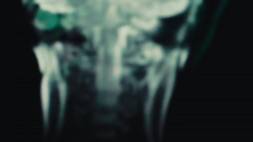 Medical scan of a human head and neck in motion with blurry green and blue tones illustrating fast movement and nervous system activity