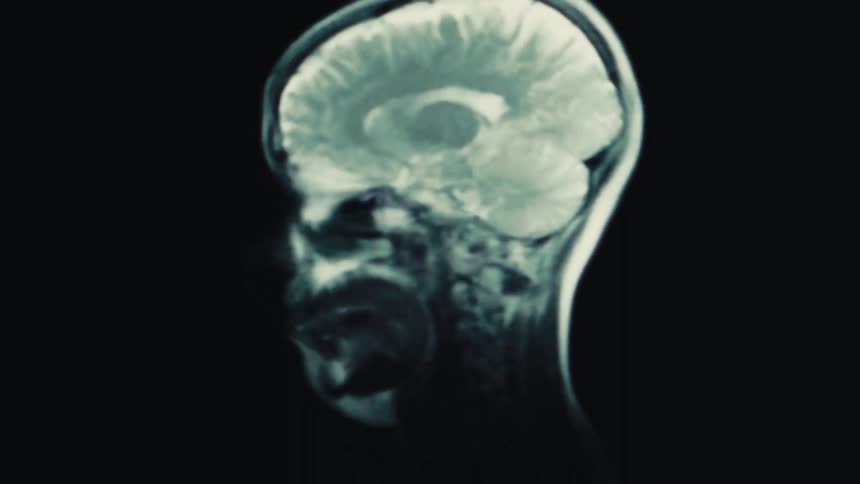 Layered MRI image montage showing various angles of a human brain and head, combining anatomical perspectives for educational or diagnostic use