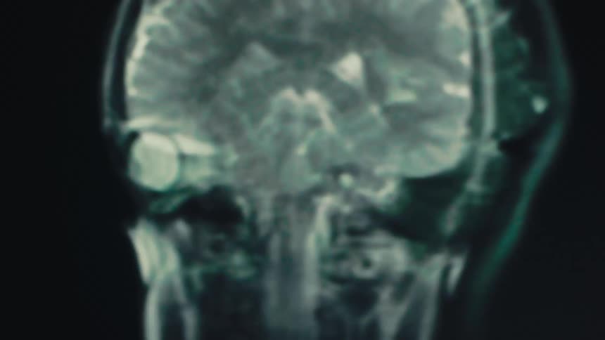 MRI scan image revealing human brain anatomy in clear frontal view, focusing on neural structure and vertical brain pattern for diagnostic and educational use