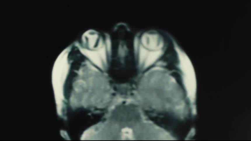 A blurred medical scan of a human skull appears against a dark background