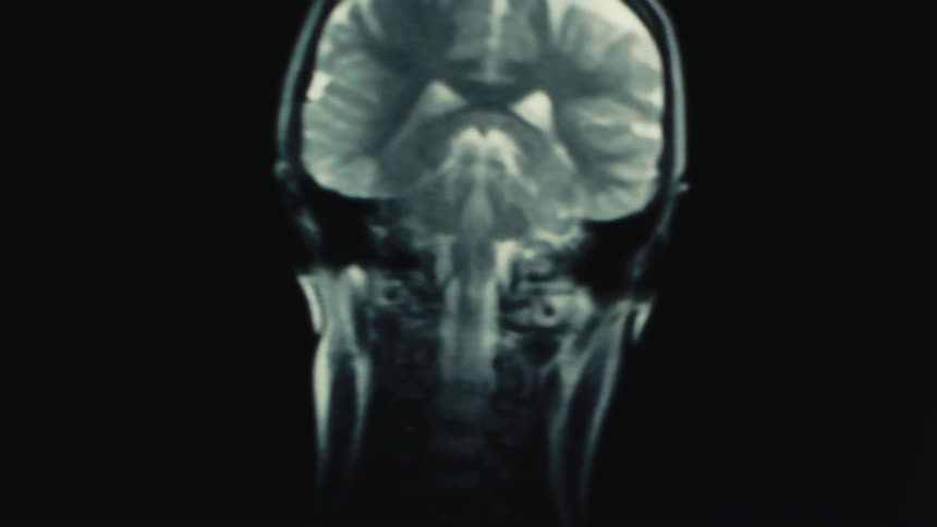 Detailed MRI scan showcasing the internal anatomy of the human brain with frontal view in sharp focus, emphasizing medical and scientific diagnostic concept