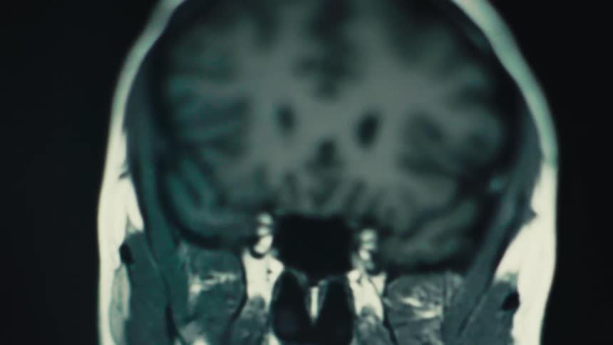 MRI scan image displaying a coronal section of the human brain with symmetrical structure, revealing inner anatomical layers and precise neurological formations in clinical imaging