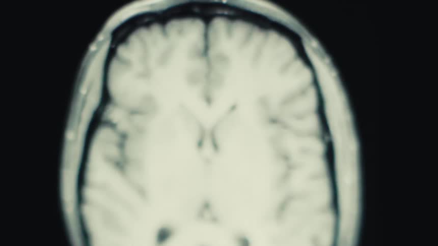 Medical time-lapse imaging of a human brain shown on a digital computer monitor with soft glowing light emphasizing brain structure and movement simulation