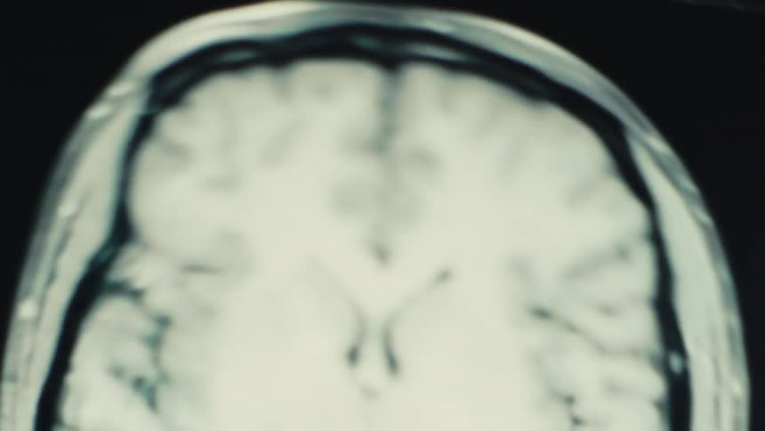A closeup view of a medical brain scan highlighting the central structures of the brain with dark contrast