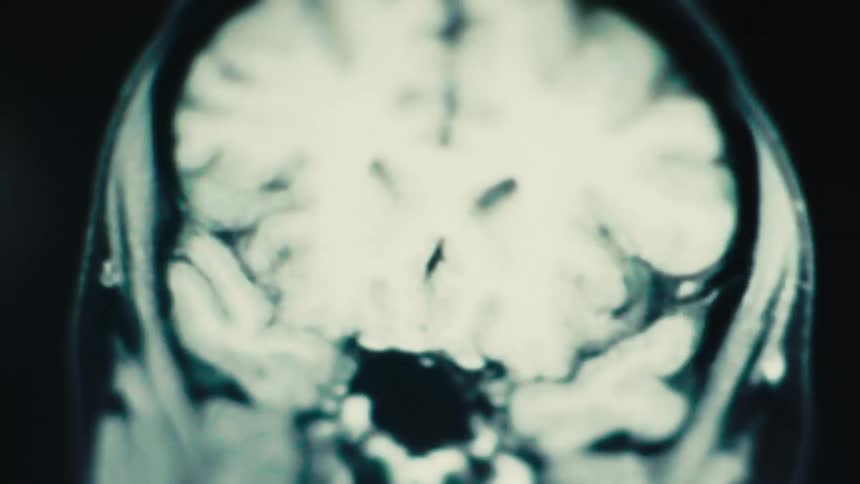 MRI scan highlighting structural details of the human brain with a white-blue color tone and slight blur emphasizing internal patterns and complex anatomy