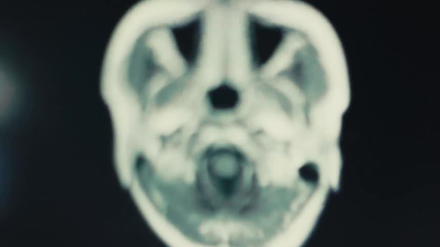 Blurred medical scan capturing upper part of a human brain and skull in motion, evoking a sense of movement and ambiguity in neurological imaging