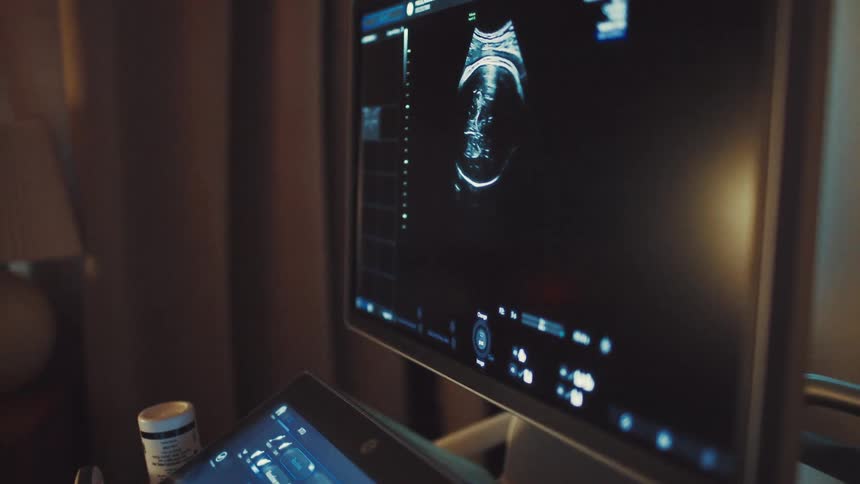 Hospital computer screen showing an ultrasound image of a baby
