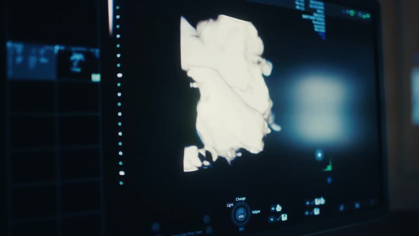 A 3d ultrasound of a fetus is displayed on a medical monitor the image is rendered in white on a dark background