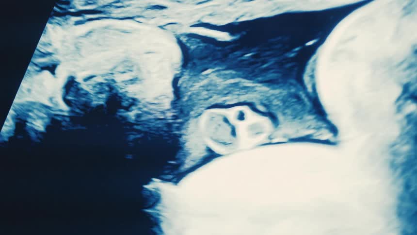 Ultrasound image of a baby scan on a computer screen