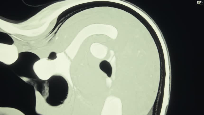 A video shows an mri scan of the human shoulder zooming in on the joint and bone structures