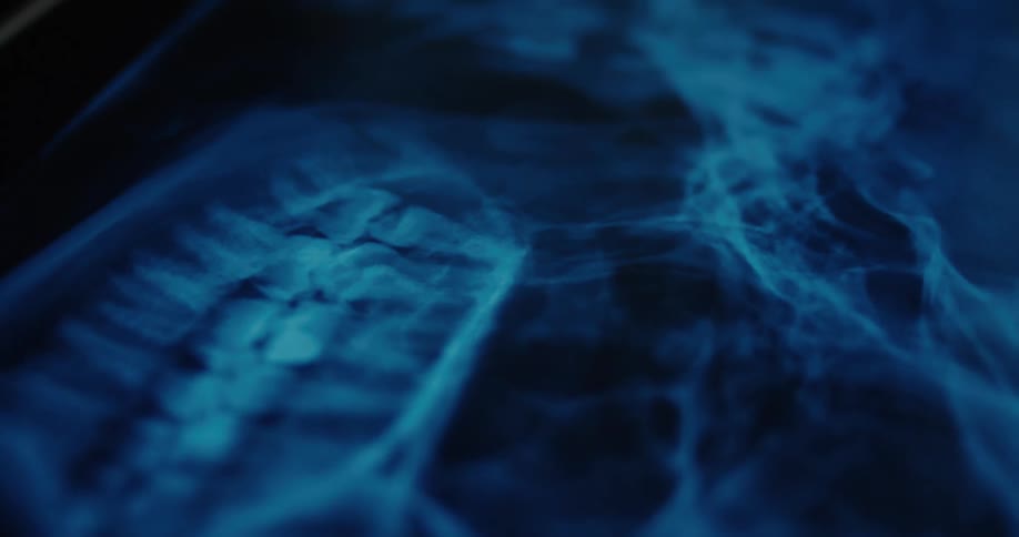 Bluish xray showing spinal column with pelvis partially visible on the right