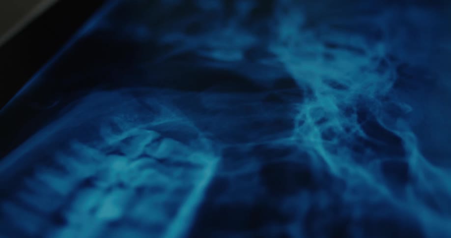 Bluish xray of cervical spine and skull base with vertebrae and cranial structure highlighted