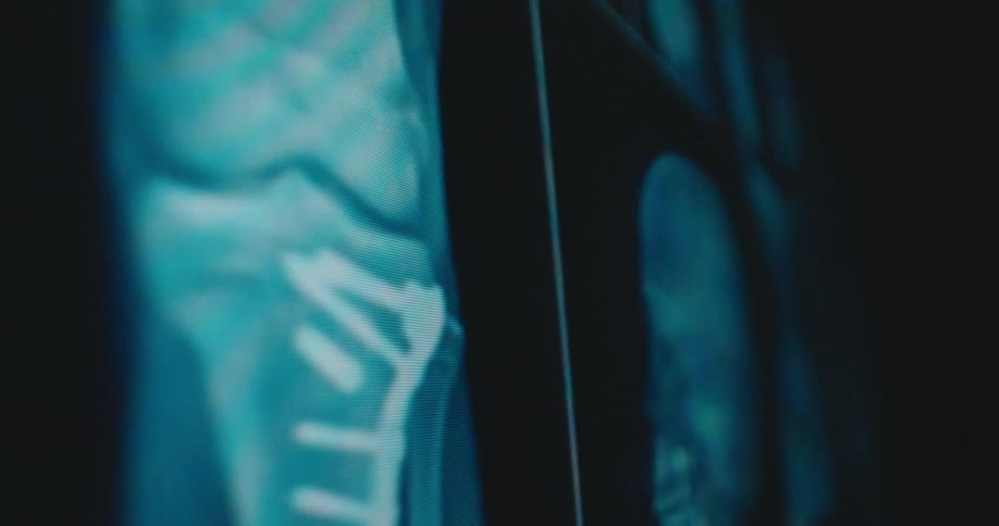 A camera pans across several glowing blue medical xray scans on a digital display showing detailed skeletal views of a human skull a knee joint with surgical hardware and a rib cage