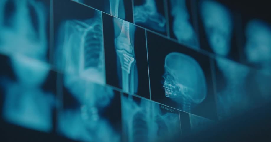 Xray scans displayed on a screen showing human skeletal images in blue tones