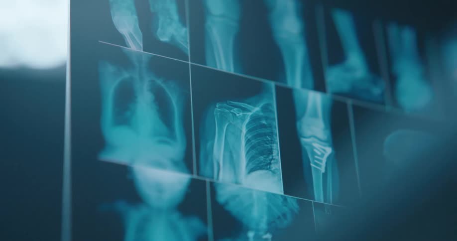 A closeup panning shot shows a collection of bluetoned medical xrays displaying various human bones including ribs shoulders and knees mounted on a lighted viewing board in a dim clinical environment