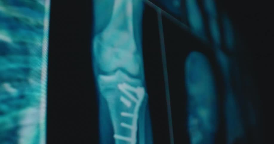 Aligned medical xrays display chest images in blue tones