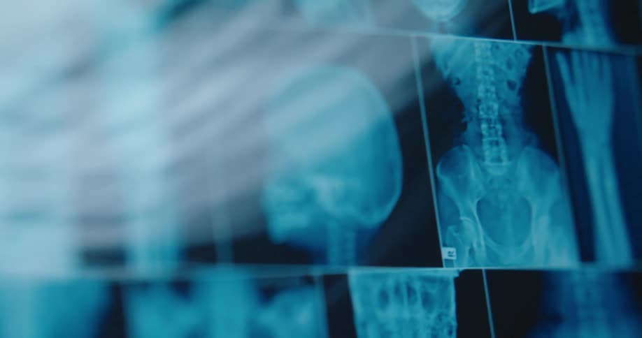 Medical xrays display bone structures and orthopedic implants