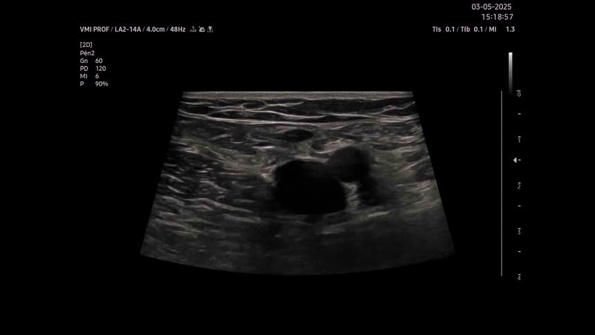 A medical ultrasound display shows a dark oval shaped area of fluid or tissue within a grainy grey background with white text and numerical data visible along the top and left edges of the screen