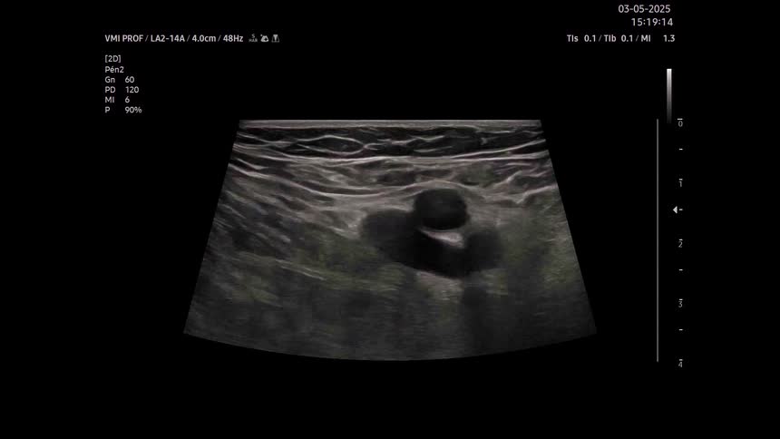 A medical ultrasound scan likely of soft tissue or a vascular area capturing a live grayscale view of internal structures the footage displays a dark fluidfilled pocket or vessel while the probe moves slightly to provide different perspectives of the