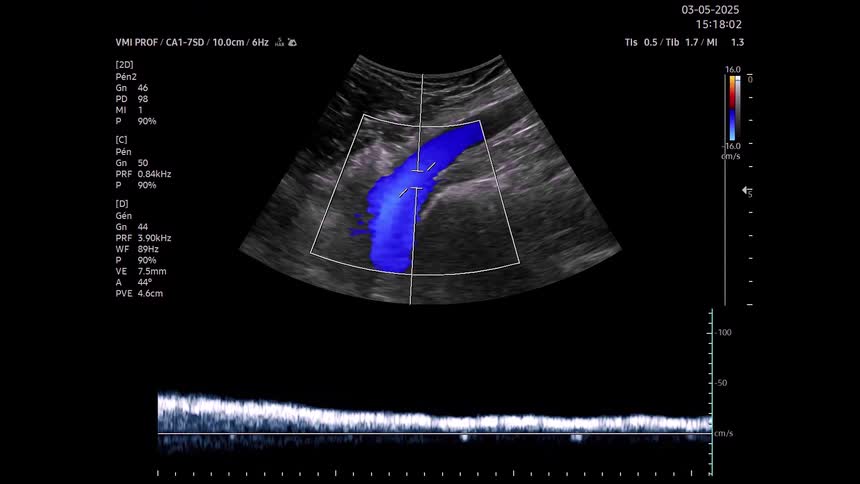 A medical ultrasound shows a black and white scan of internal body tissue while a center section displays blue and red colors indicating fluid flow above a fluctuating wave graph