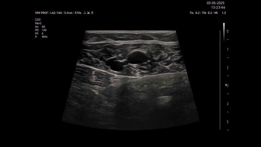 A medical ultrasound shows a black and white scan of internal body tissue with various dark fluid areas and grainy structures
