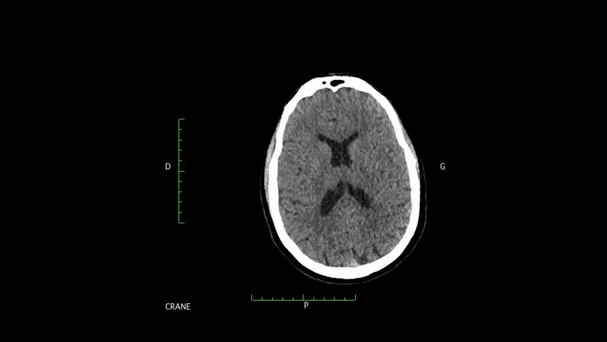 A medical scan displays a series of black and white cross section images of a human brain on a dark background