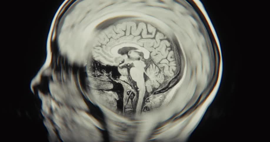 A close-up, distorted view reveals a cycling black and white MRI scan of a human head, showing the various layers of the brain and skull