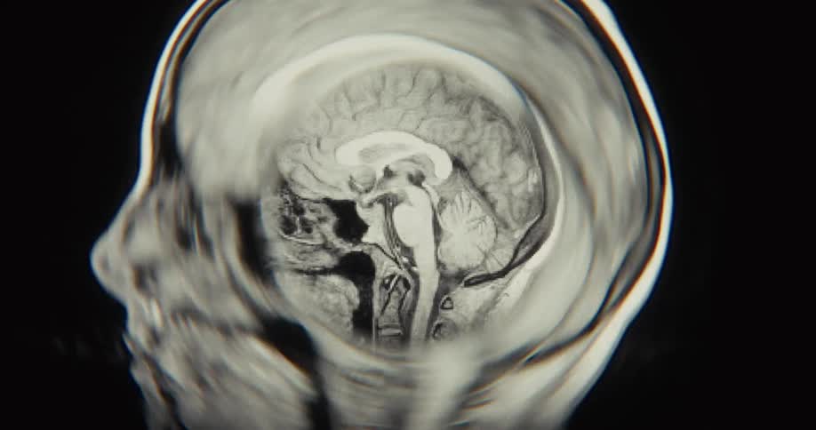 Close up of a black and white sagittal MRI brain scan with a warping, liquid-like effect