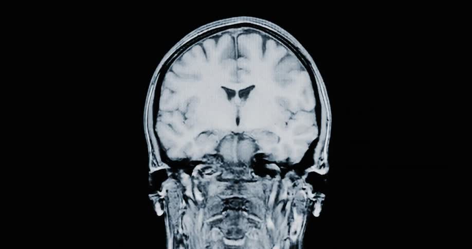 A detailed MRI scan animates through the cross-sections of a human brain from a coronal view