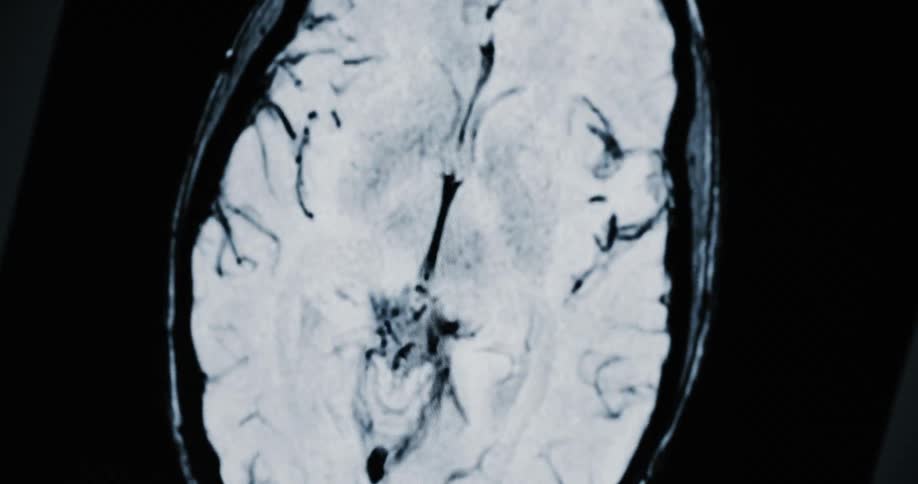 An animated, black and white magnetic resonance imaging (MRI) scan of a human brain reveals its intricate structures