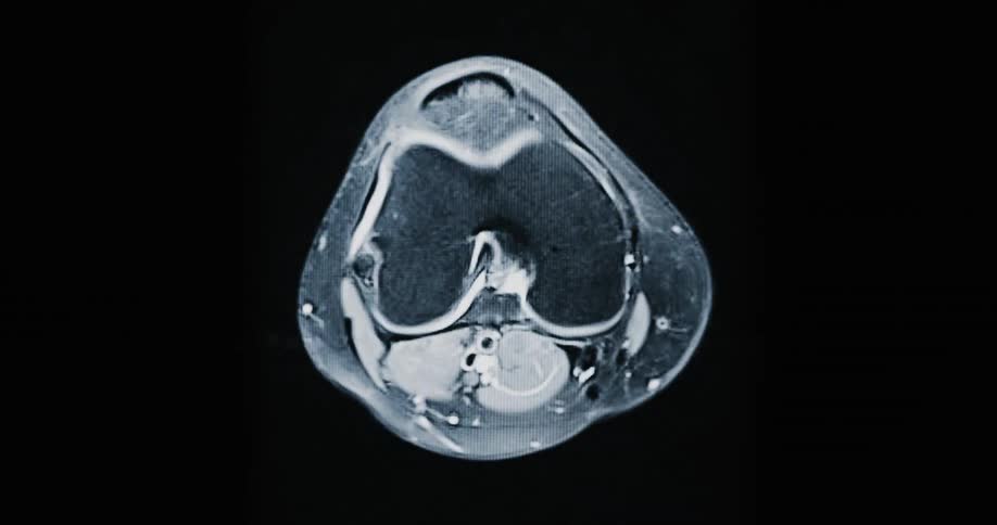 Animated MRI scan reveals a detailed cross-section of a human knee joint, showing bones and surrounding tissue