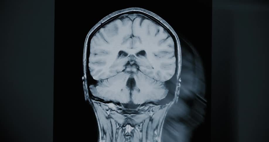 An animated medical MRI scan revealing the internal cross-sections of a human brain