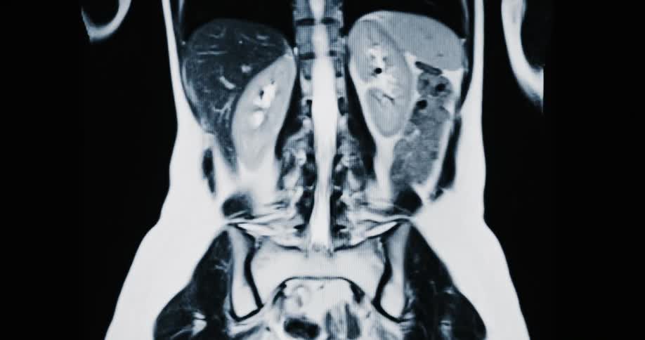 A coronal MRI scan of a human abdomen and torso revealing internal organs like the spine, kidneys, and intestines