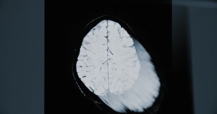 Close up of a real-time MRI scan of a human brain showing the different layers of the organ