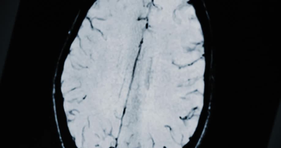 An abstract shot slowly resolves into a detailed MRI scan of a human brain, with the camera panning across various sections
