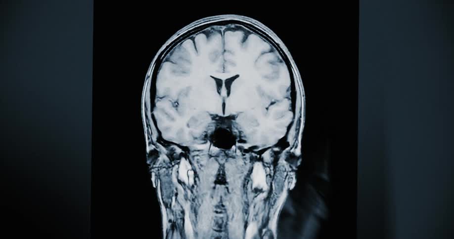 Animated coronal view of a human head MRI scan, progressively revealing the brain and skull