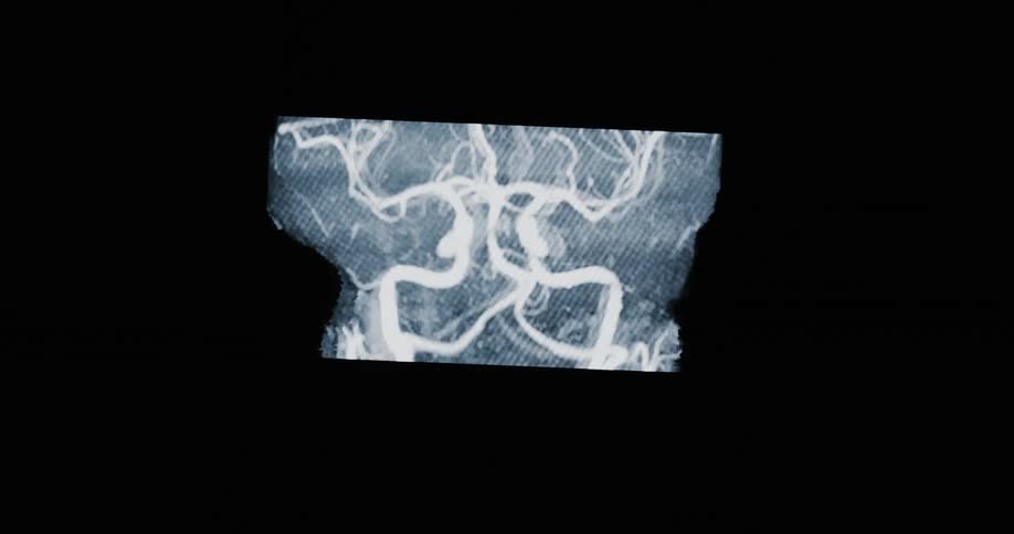 An animated MRA scan reveals the intricate network of blood vessels within the human brain on a dark background