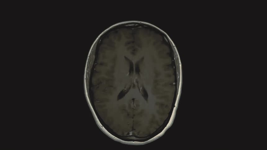 A looping animation shows an axial view of a human head MRI, scanning from the nasal cavity up through the brain