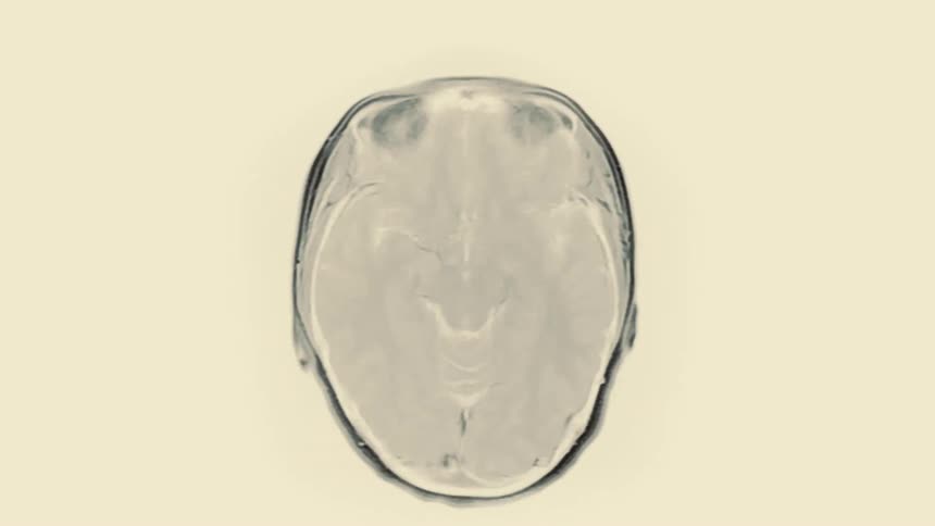 A fast-paced, glitchy animation of an MRI scan showing various cross-sections of a human brain and skull