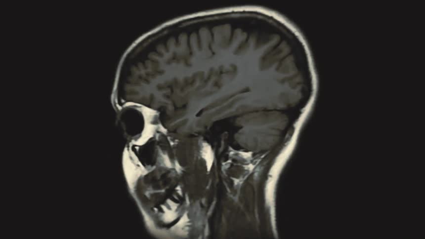 An animated medical visualization showing a human brain scan from both axial and sagittal views on a black background