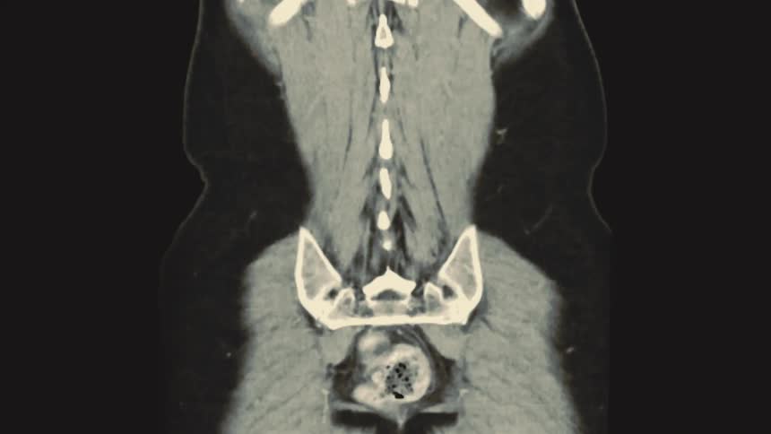 A medical computed tomography scan animates through the human torso, revealing internal organs and skeletal structure