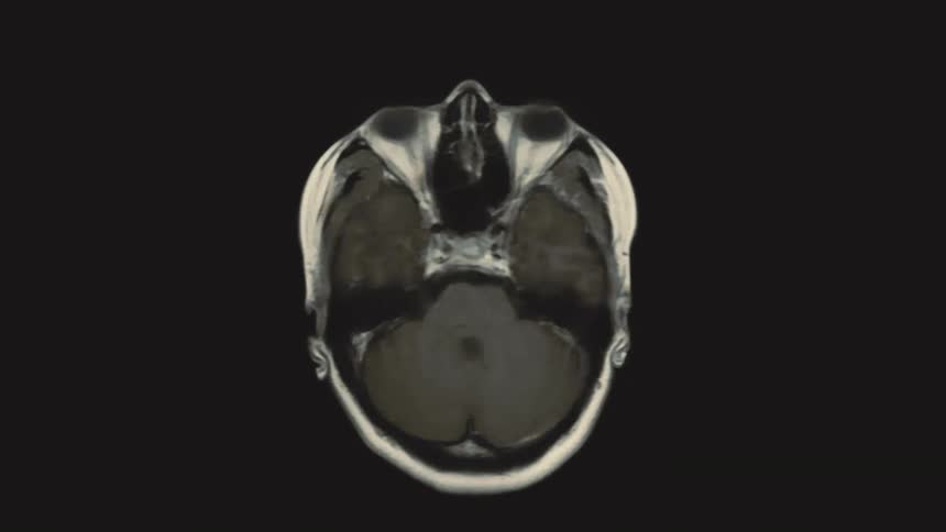 A looping animation of axial MRI slices of a human head reveals the intricate structures of the brain