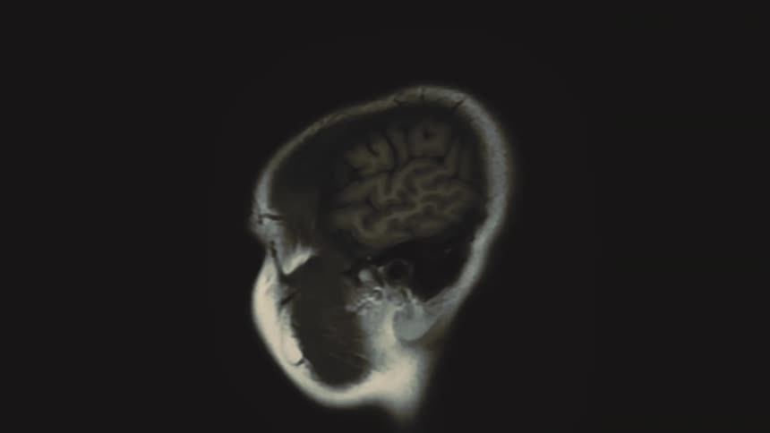 An animated sequence of MRI brain scans showing various cross-sections of a human head on a black background