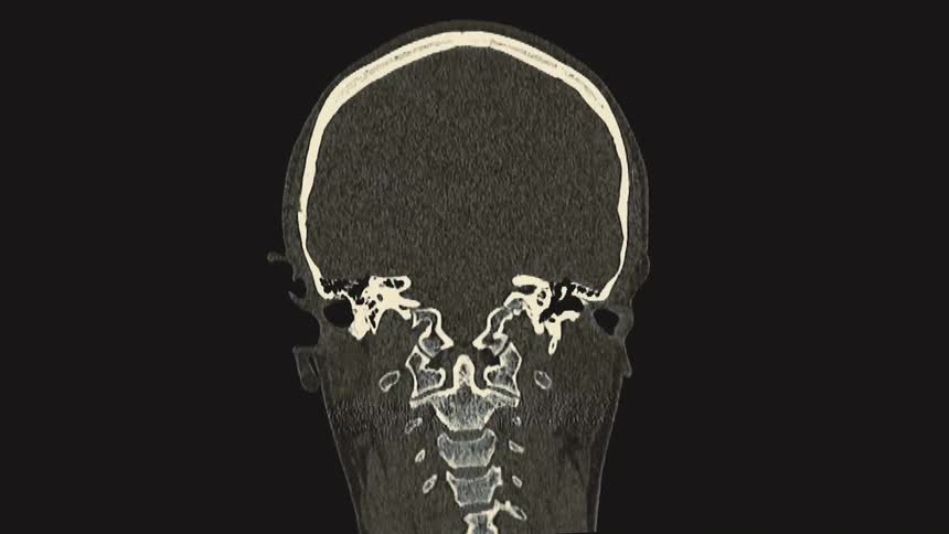 A detailed compilation of CT scan animations showing the human skull and upper spine from various anatomical perspectives